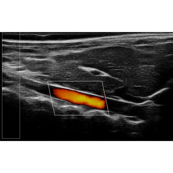 What Is a Laser Speckle Contrast Imaging System?