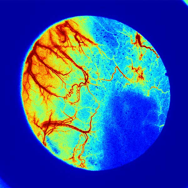 How Is LSCI Applied in Dermatology and Burn Wound Assessment?